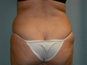 Liposuction