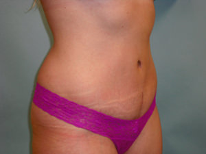 Tummy Tuck