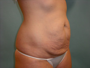 Tummy Tuck