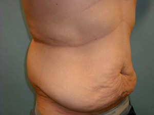 Tummy Tuck