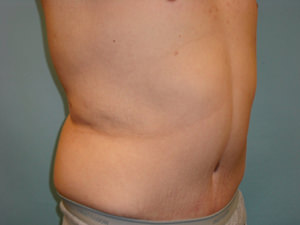 Tummy Tuck