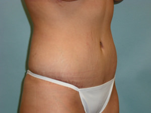 Tummy Tuck