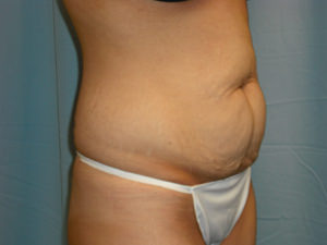 Tummy Tuck