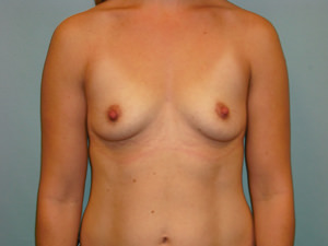 Breast Augmentation