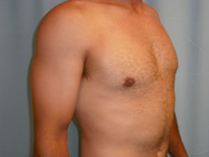 Male Breast Reduction - Gynecomastia