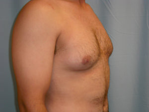 Male Breast Reduction - Gynecomastia