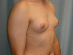 Male Breast Reduction - Gynecomastia