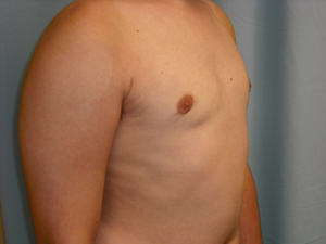 Male Breast Reduction - Gynecomastia