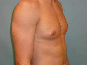 Male Breast Reduction - Gynecomastia