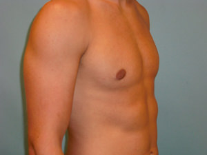 Male Breast Reduction - Gynecomastia