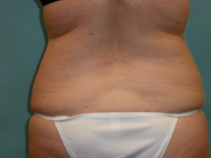 Liposuction