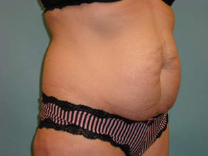 Tummy Tuck