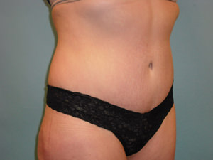 Tummy Tuck