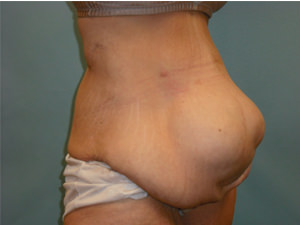 Tummy Tuck