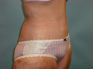 Tummy Tuck