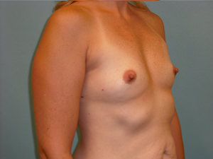 Breast Augmentation