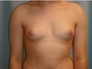 Male Breast Reduction - Gynecomastia