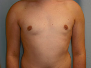 Male Breast Reduction - Gynecomastia