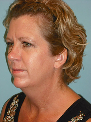 Facelift