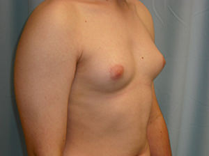 Male Breast Reduction - Gynecomastia