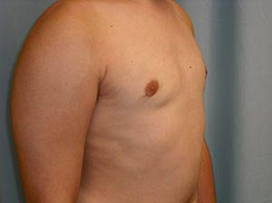 Male Breast Reduction - Gynecomastia