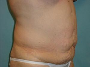 Tummy Tuck