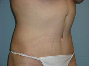 Tummy Tuck