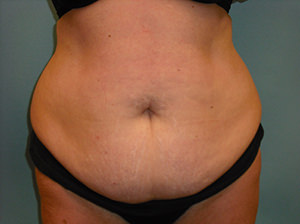 Tummy Tuck