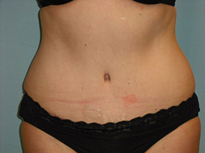 Tummy Tuck