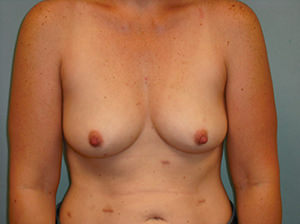 Breast Augmentation