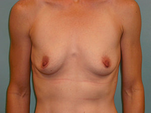 Breast Augmentation