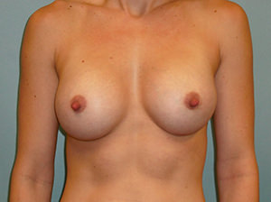 Breast Augmentation