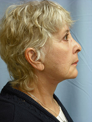 Facelift