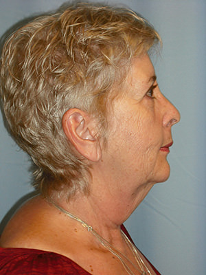 Facelift