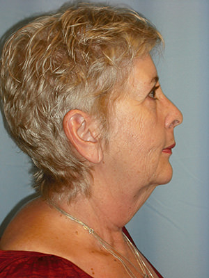 Neck Lift