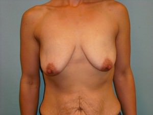 Breast Lift (Mastopexy)