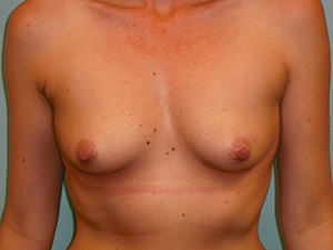 Breast Augmentation