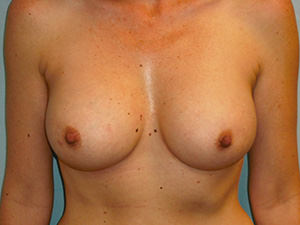 Breast Augmentation