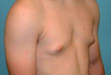 Before Image of Male Plastic Surgery Scottsdale