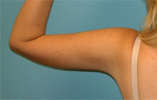 arm lift after procedure Scottsdale, AZ