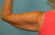 arm lift before procedure Scottsdale, AZ