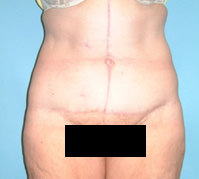 body lift after surgery Scottsdale, AZ
