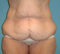 body lift before surgery Scottsdale, AZ