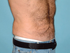 After Image of Male Liposuction Scottsdale