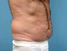 Before Image of Male Liposuction Scottsdale