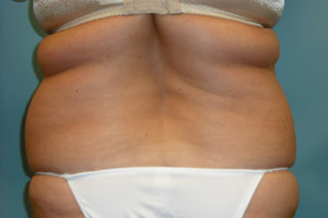 Liposuction