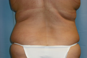 Liposuction