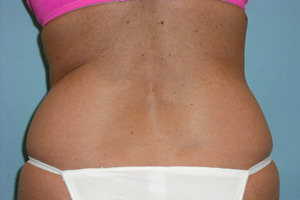 Liposuction