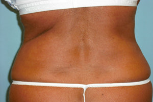 Liposuction