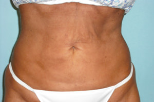 Liposuction